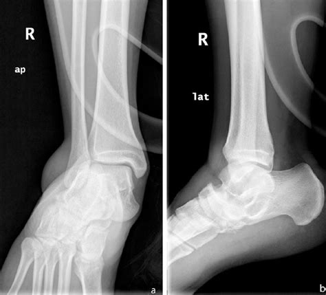 Subtalar dislocation: management and prognosis for an 